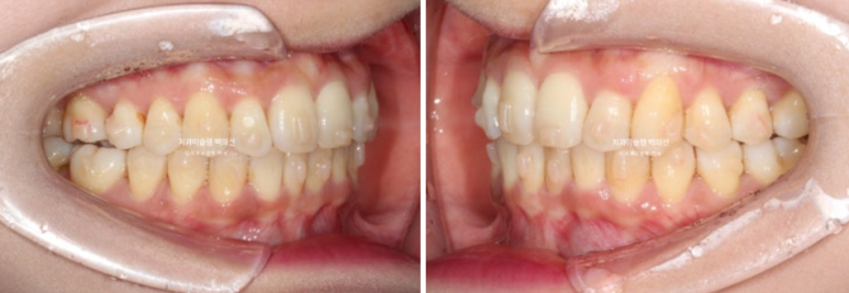 옥니 덧니 과개교합 반대교합 중심선 인비절라인 치료기간 1년 관련 이미지 8