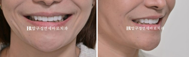 Can Gaps Between the Front Teeth Be Treated with No-Prep Veneers Alone? A Real Case Completed with Gelami After Invisalign Lite image 20