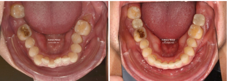 40대 인비절라인 라이트 과개교합 과잉치 덧니 교정 임플란트 보철 교정 후기 관련 이미지 19