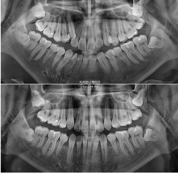 투명교정 인비절라인 덧니 교정 치료기간 알아보기 관련 이미지 17