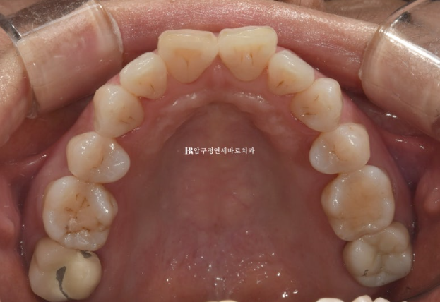 50대 치아교정 인비절라인 라이트 앞니교정 치료 후기 관련 이미지 5