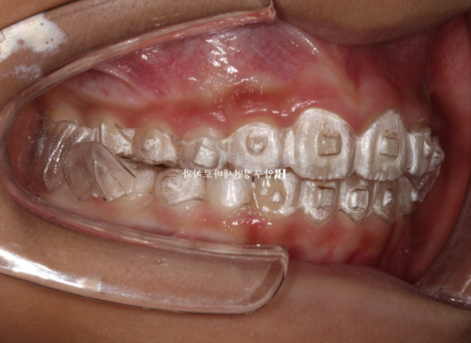 무턱교정 어린이 투명교정 인비절라인 퍼스트 교정 후기 관련 이미지 10