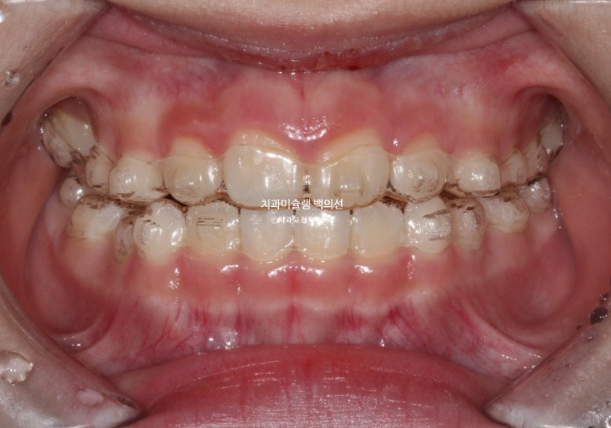 어린이 비대칭 반대교합 주걱턱 인비절라인 퍼스트 프리올소 성장 교정 관련 이미지 12