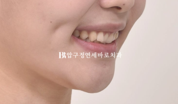 If Inward-Tilted Teeth Make Your Smile Look Constricted? Invisalign Before and After image 5