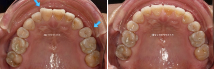 50대 라미네이트 삭제 없이 하는 법? 관련 이미지 6