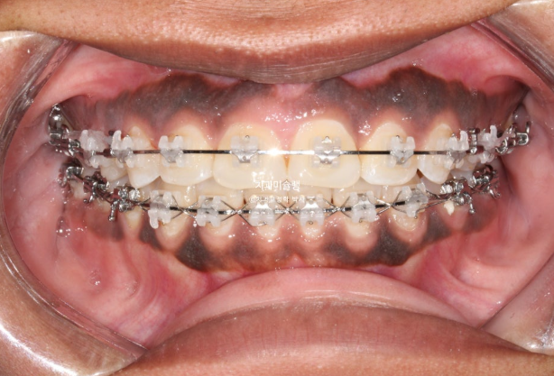 Extraction & re-orthodontics with Clippy-C, intrusion for dental implant. 관련 이미지 12
