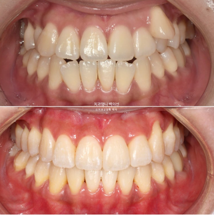 비발치 교정 덧니 인비절라인 교정 절단교합 반대교합 치료기간 1년 6개월 관련 이미지 21