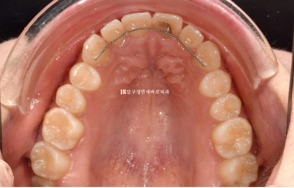 How to Create a Beautiful Smile Line? | A Real Case of Changing a Smile with No-Prep Laminates image 6