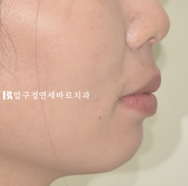 웃을 때 잇몸이 많이 보인다면? 거미스마일 원인과 교정 방법 관련 이미지 2