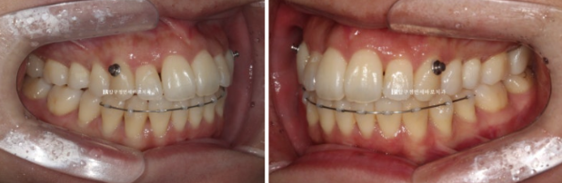 예비신부 교정 단기 앞니 부분교정 치료기간 6개월 관련 이미지 10