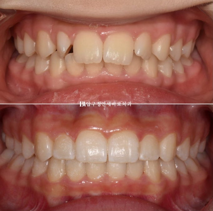 인비절라인라이트 덧니 과개교합 교정 치료기간 9개월 관련 이미지 11
