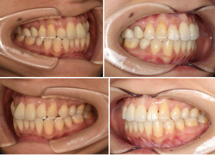 30대 토끼이빨 교정 반대교합 앞니 부분교정 후기 관련 이미지 7