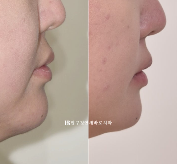 서울 인비절라인 치과 재교정 뻐드렁니 교정 관련 이미지 10