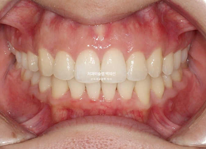 비발치 인비절라인 교정 돌출입 교정 후기 관련 이미지 14