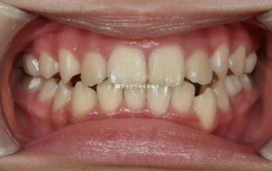 어린이 투명교정 인비절라인 틴 덧니 교정 후기 관련 이미지 4