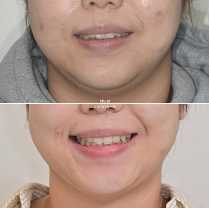 돌출입 교정 인비절라인 발치 교정 개방교합 치료 후기 관련 이미지 26