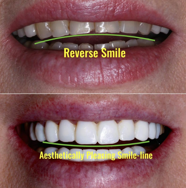 How to Create a Beautiful Smile Line? | A Real Case of Changing a Smile with No-Prep Laminates image 4