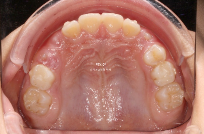 인비절라인퍼스트 어린이 투명교정 과개교합 덧니 악궁확장 돌출 관련 이미지 13