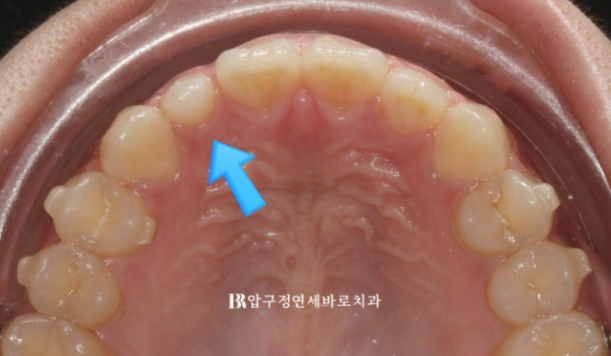 왜소치 인비절라인 라이트 교정 / 무삭제 라미네이트 젤라미 관련 이미지 7
