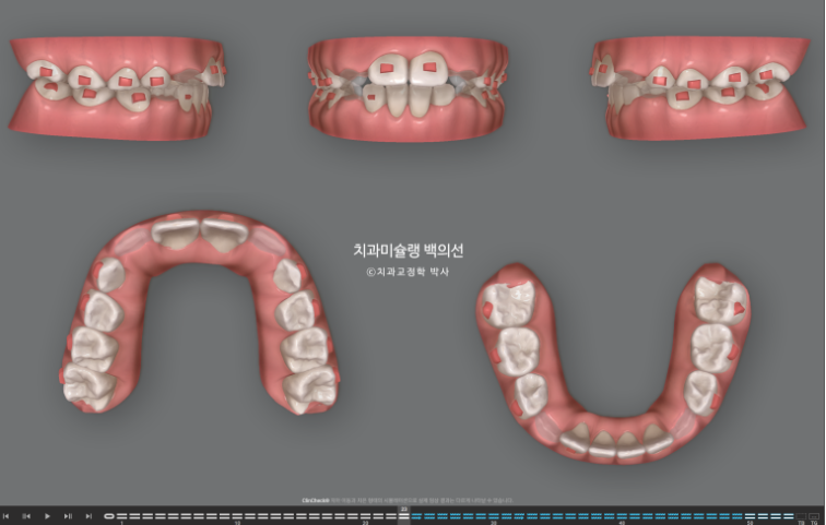 어린이 무턱 성장교정 덧니 인비절라인 퍼스트 악궁확장 치료기간 2년 관련 이미지 7