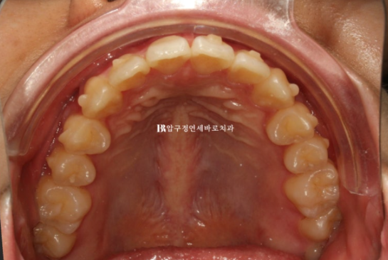 인비절라인 익스프레스 토끼이빨 교정 기간? 인비절라인 종류는? 관련 이미지 8