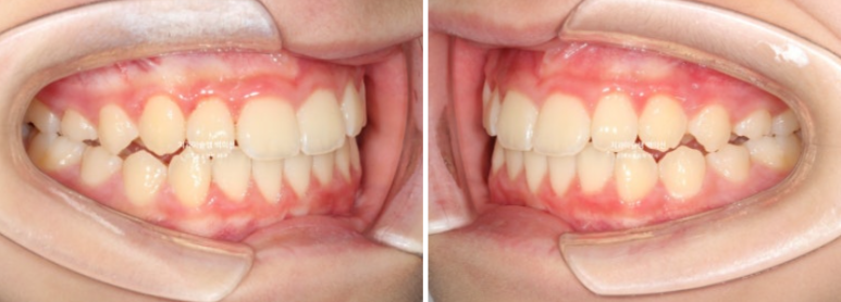 어린이 무턱 성장교정 덧니 인비절라인 퍼스트 악궁확장 치료기간 2년 관련 이미지 23