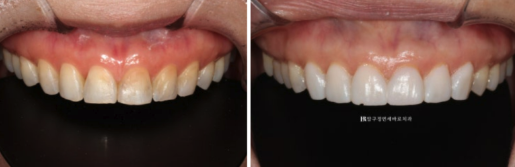Laminate Veneers in Your 50s: Is It Possible Without Shaving Down the Teeth? | No-Prep Laminate Veneers + Real Case of Front Tooth Partial Orthodontics image 6