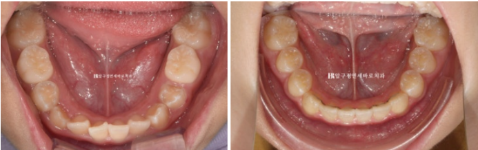 Simultaneous Arch Expansion and Teeth Alignment for Elementary School Children with Invisalign｜Invisalign First image 15