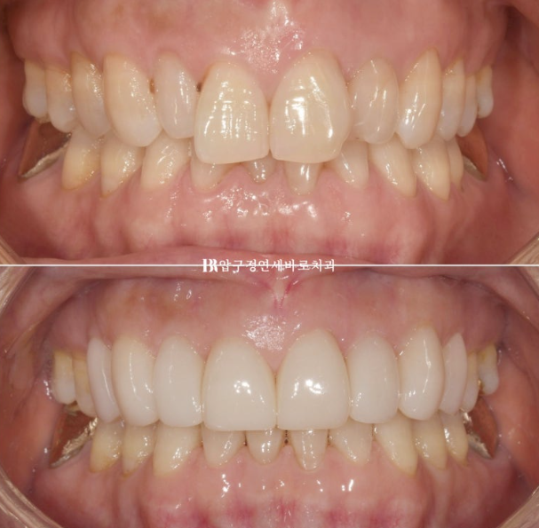 50s Invisalign Lite No-Prep Laminate Bunny Teeth image 14