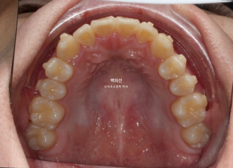 유학생 교정 덧니 반대교합 인비절라인 라이트 치료기간 관련 이미지 9