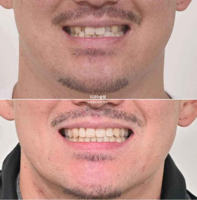 30대 MSE 악궁확장 덧니 반대교합 비발치 클리피씨 부작용 관련 이미지 18