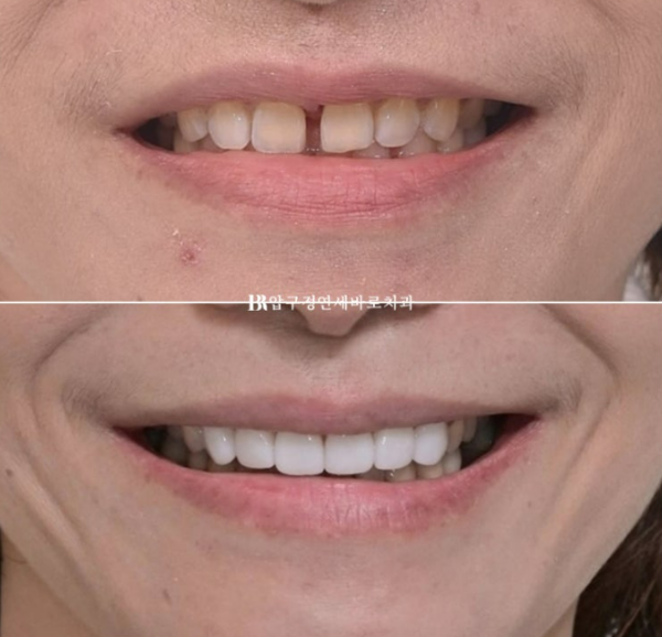 Can Gaps Between the Front Teeth Be Treated with No-Prep Veneers Alone? A Real Case Completed with Gelami After Invisalign Lite image 24