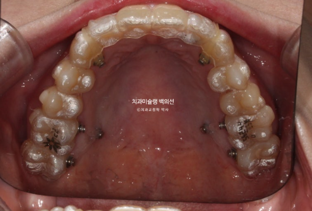 잇몸미소 인비절라인 거미스마일 토끼이빨 교정 무삭제 라미네이트 반대교합 치료 후기 관련 이미지 7