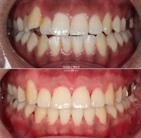 반대교합 비발치 교정 클리피씨 후기 관련 이미지 1