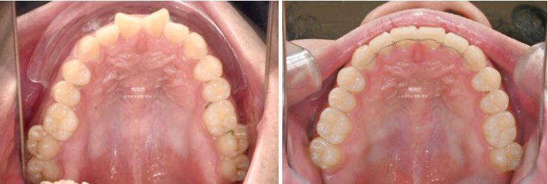 가위교합 나비치아 미니스크류 덧니 교정 인비절라인 라이트 관련 이미지 18