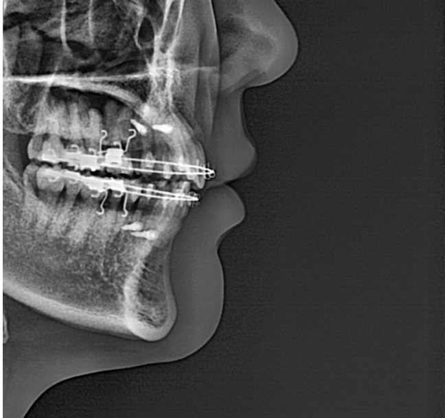 30대 돌출입 발치교정 입술부전증 치료 관련 이미지 6