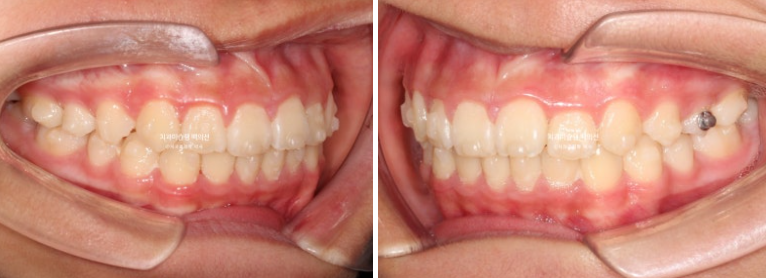 덧니 반대교합 과개교합 인비절라인 퍼스트 악궁확장 어린이 교정 치료 관련 이미지 16