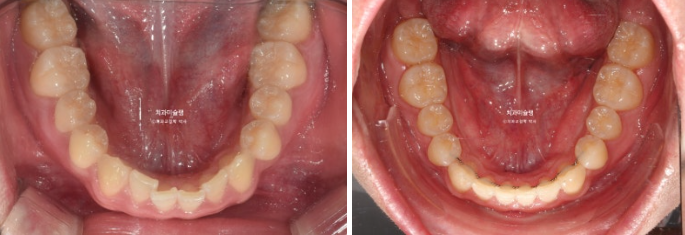 비대칭 비발치 거미스마일 잇몸미소 중심선 가위교합치료 무삭제 라미네이트 관련 이미지 23