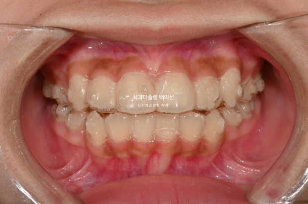 돌출입 무턱 인비절라인 발치교정 덧니 치료기간 1년 11개월 관련 이미지 7