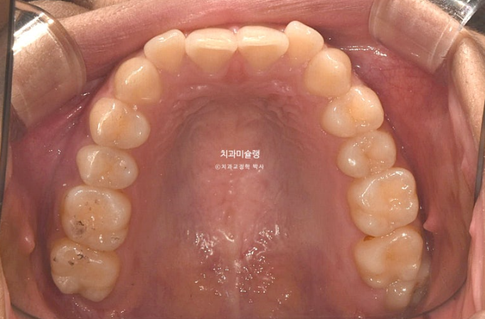 유학생 치아교정 해외거주 한국에서 치아교정? 관련 이미지 5