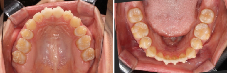 클리피씨 교정에서 인비절라인 변경 마무리 인비절라인 라이트 치료기간 4개월 관련 이미지 8