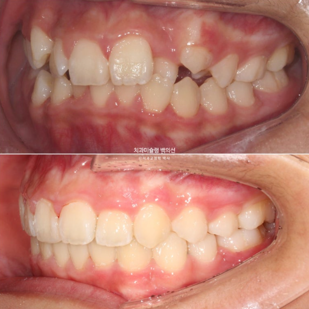 덧니 반대교합 과개교합 인비절라인 퍼스트 악궁확장 어린이 교정 관련 이미지 22