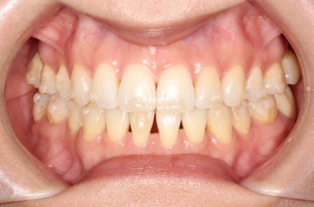 인비절라인 익스프레스 재교정 블랙트라이앵글 치간 삭제 치료기간 6개월 재제작 1회 관련 이미지 7