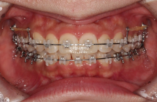 Inward-Tilted Teeth Orthodontic Treatment Review | A Real Case of Treating Congenitally Missing Lower Incisor (Three Lower Front Teeth) Without Extractions image 6
