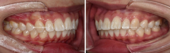 How Do the Buccal Corridors and Smile Line Change After Extraction Treatment for Protruding Teeth?|An Orthodontic Case That Also Improved Lip Incompetence image 3