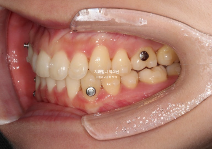 인비절라인 교정 비발치 비대칭 덧니 중심선 선천적 결손치 교정? 관련 이미지 10