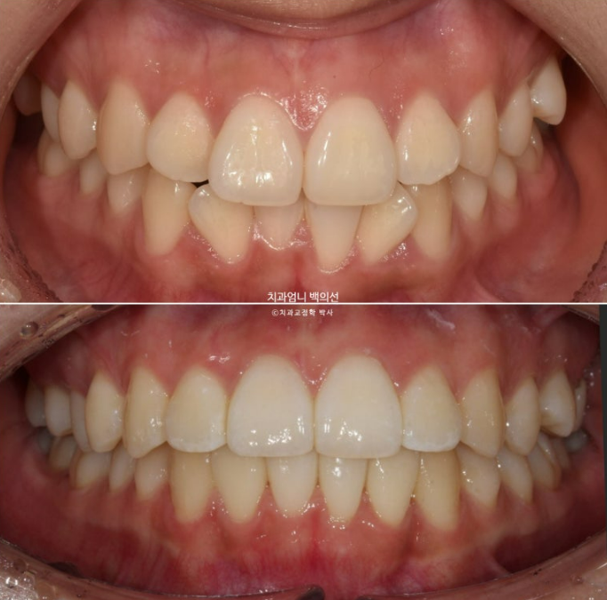 앞니 부분 교정 급속 교정 토끼이빨 MTA 미니튜브 치간삭제 치료기간 9개월 관련 이미지 1