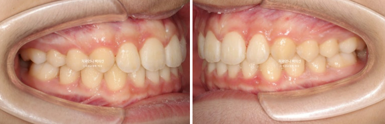 어린이 투명교정 인비절라인 퍼스트 가위교합 돌출교정 덧니교정 관련 이미지 9