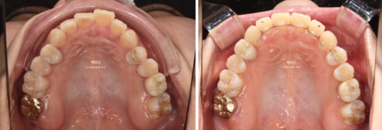 30대 비수술 비발치 주걱턱 부정교합 인비절라인 교정 관련 이미지 10