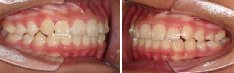 덧니 반대교합 과개교합 인비절라인 퍼스트 악궁확장 어린이 교정 치료 관련 이미지 7